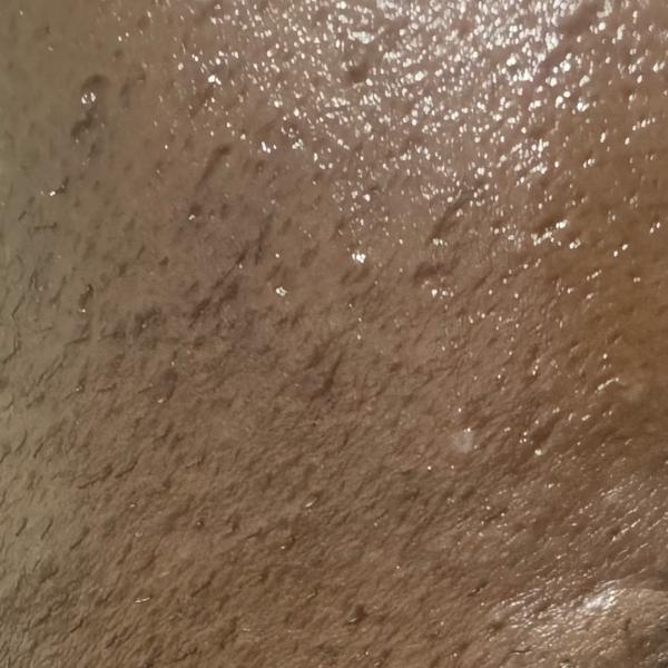 expert skin peel doctor trichy