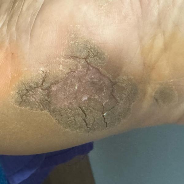 skin diseases treatment trichy
