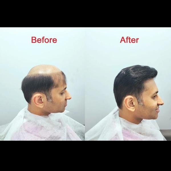 miraj hair patch in Rohini mir