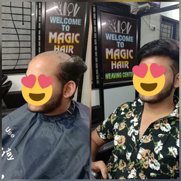 Hair loss can feel overwhelming when cha