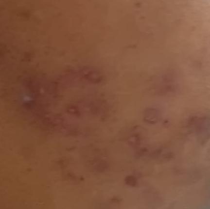dr valarmathi skin peel specia