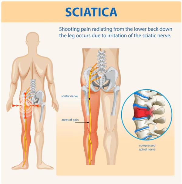 Sciatica p
