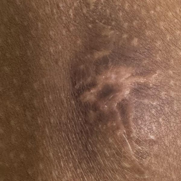 cyst removal treatment in tric