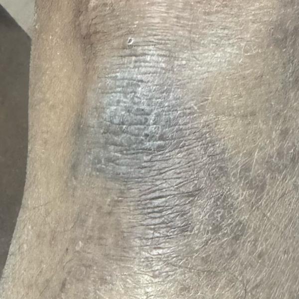 ringworm treatment in trichy