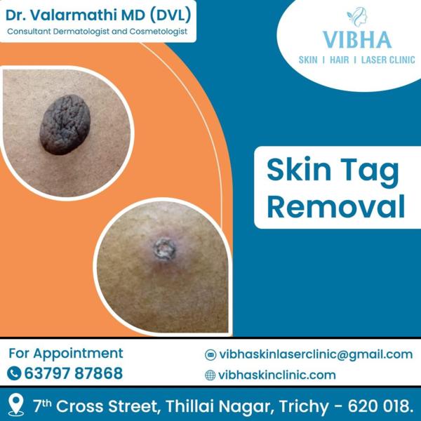 mole wart and skin tag removal
