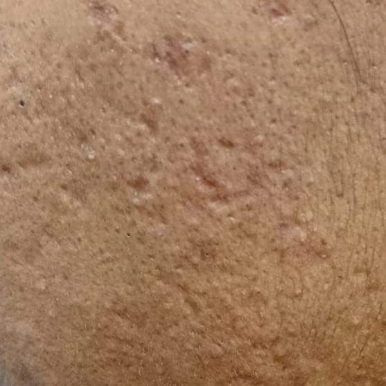 chemical peel dermatologist tr