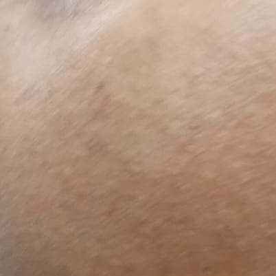 melasma treatment in trichy