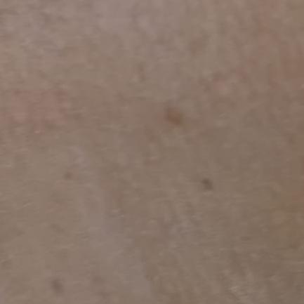 mole wart and skin tag removal
