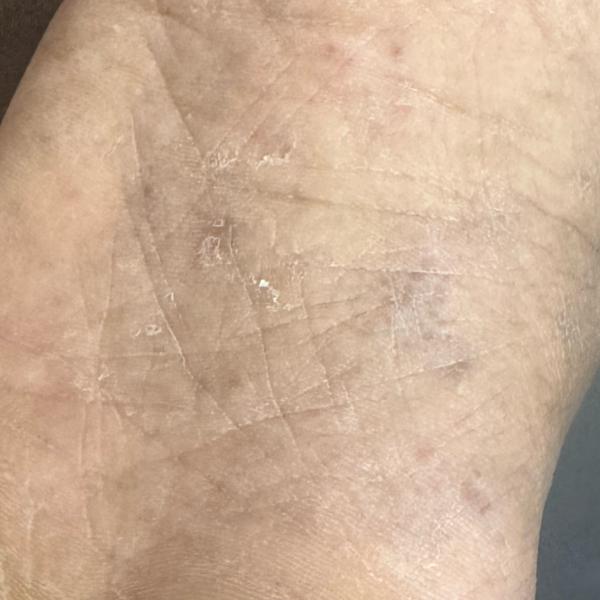 ringworm infection treatment t