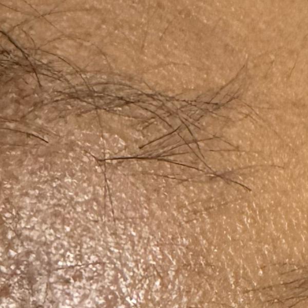 scalp baldness treatment in tr