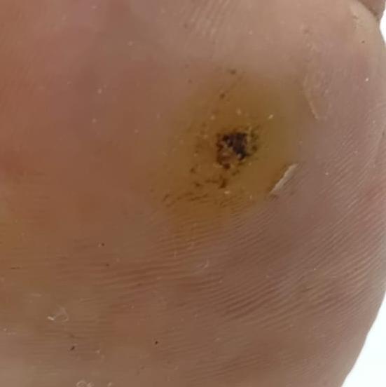 earlobe repair treatment in tr