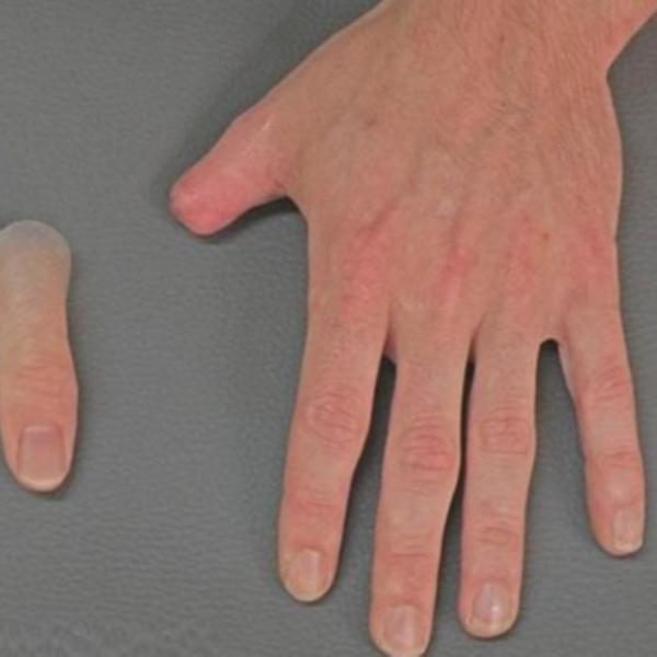 Silicone Hand and Thumb Prosthesis in Mayur Vihar 