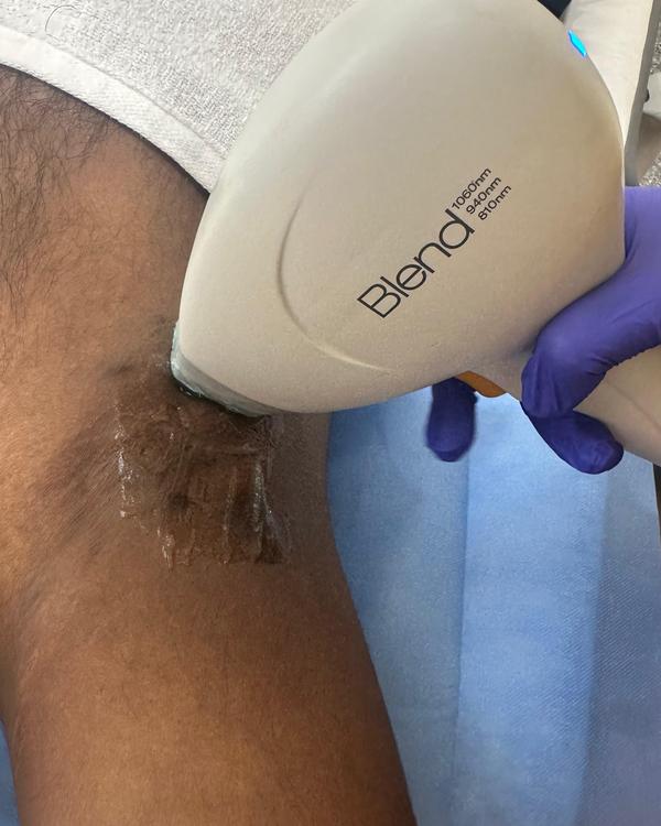 non surgical hair restoration