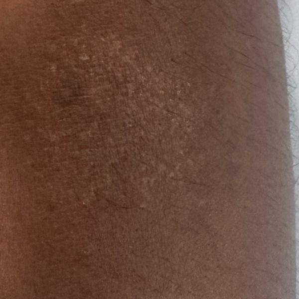 sun allergy treatment trichy