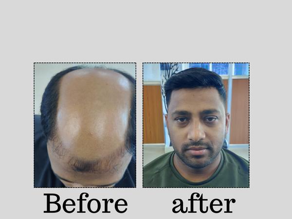 hair replacement before and after 