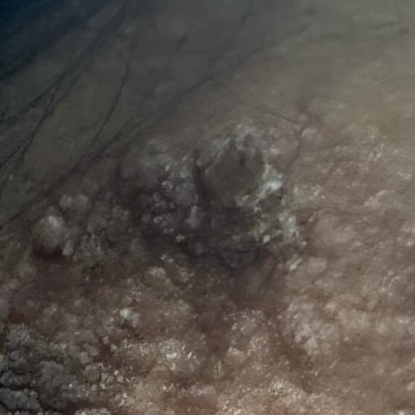 wart treatment trichy skin cli