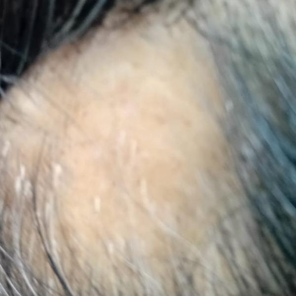 alopecia areata specialist