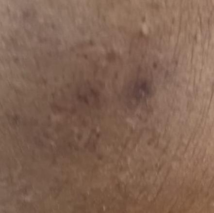 acne removal services trichy