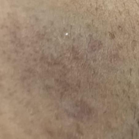 acne removal services trichy