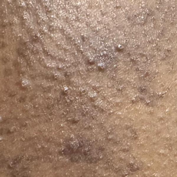 expert skin peel doctor trichy