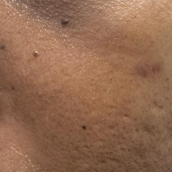 earlobe repair and corn remova