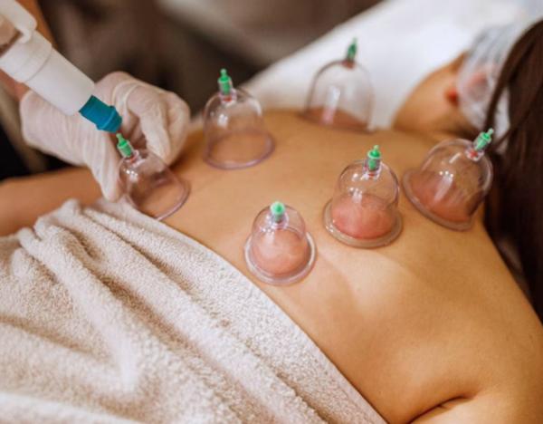 Cupping therapy has gained att