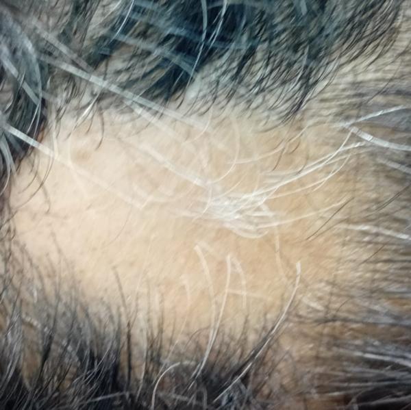 alopecia areata specialist