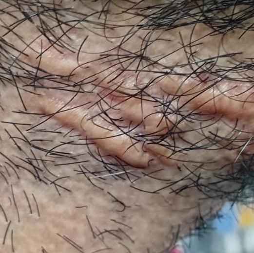 wart treatment trichy skin cli