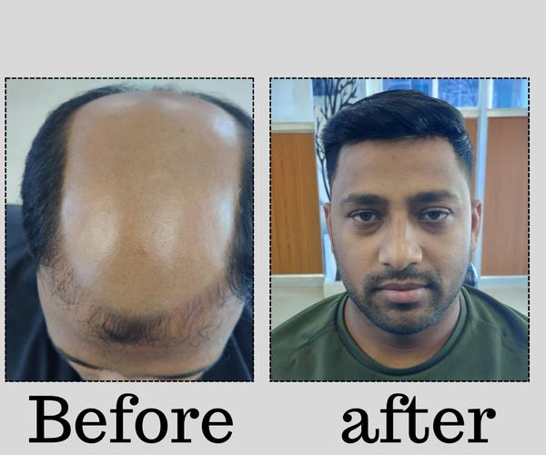 complete hair replacement centre 