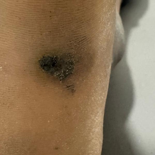 best wart removal clinic trich