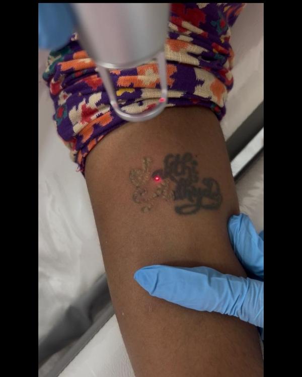 Nd:YAG Laser for Tattoo Remova
