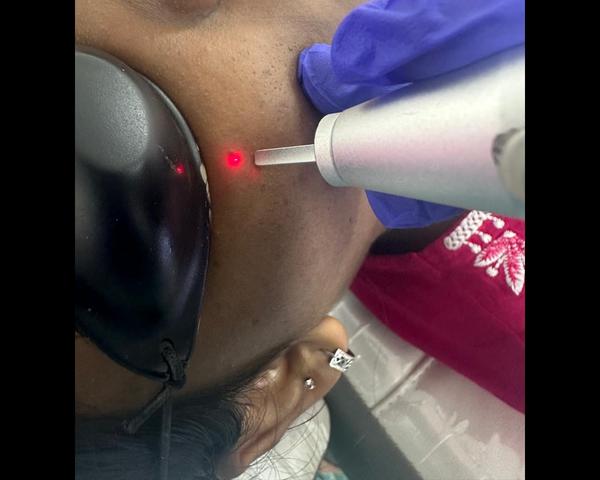 DPN Removal with CO2 Laser: Sa