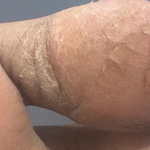 psoriasis and skin allergy tre
