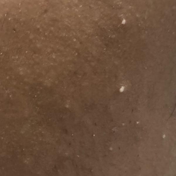 earlobe repair expert in trich