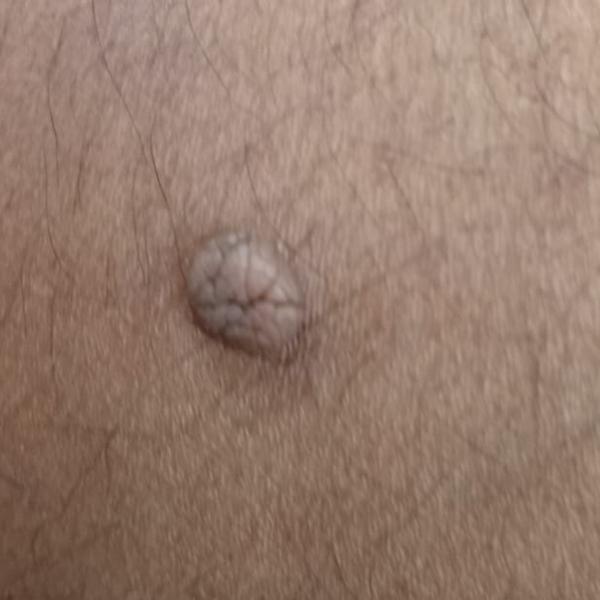 keloid removal doctor trichy