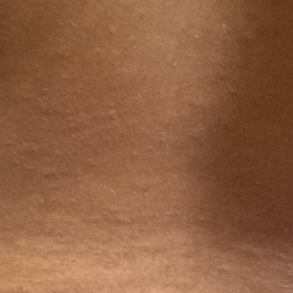 acne treatment center woraiyur