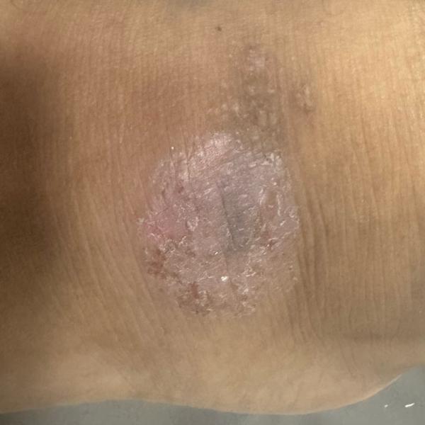 psoriasis and skin allergy tre