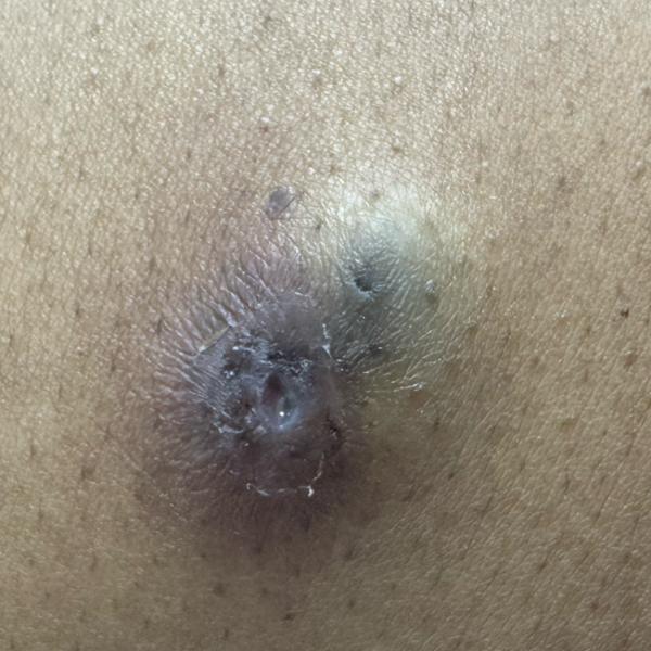 cyst removal treatment in tric