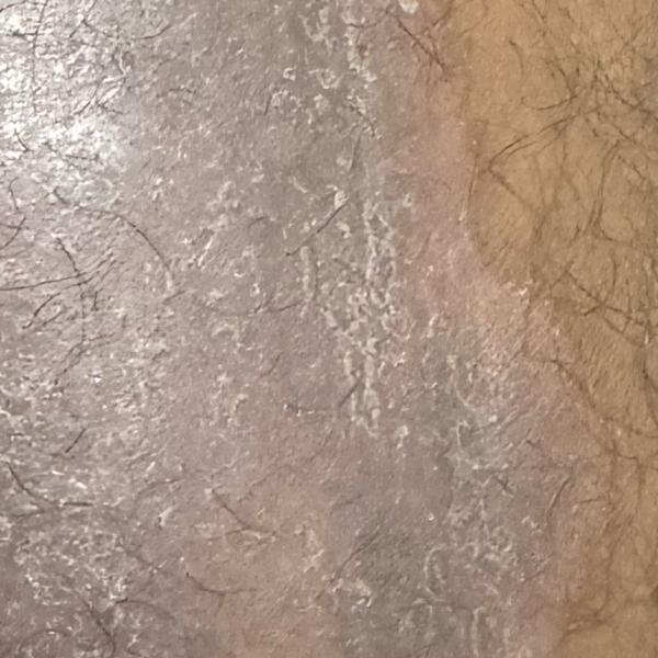 psoriasis and skin allergy tre