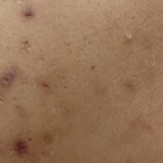 medifacial service in trichy