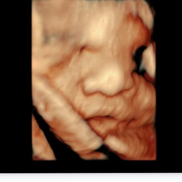 4D pregnancy ultrasound in roh