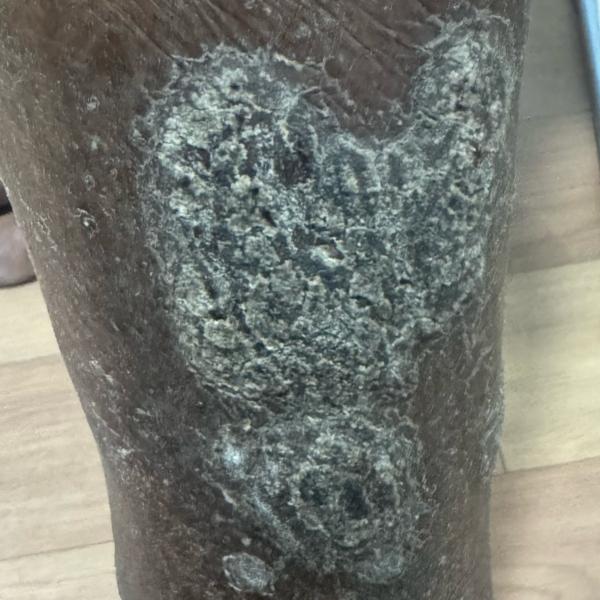 psoriasis and skin allergy tre