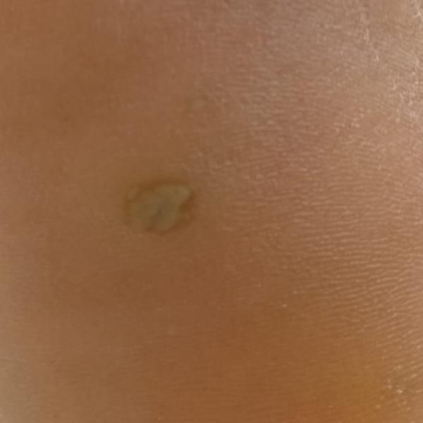 best wart removal clinic trich