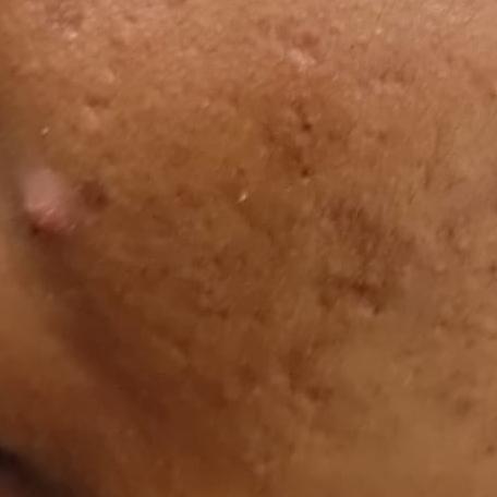 vitiligo treatment in trichy