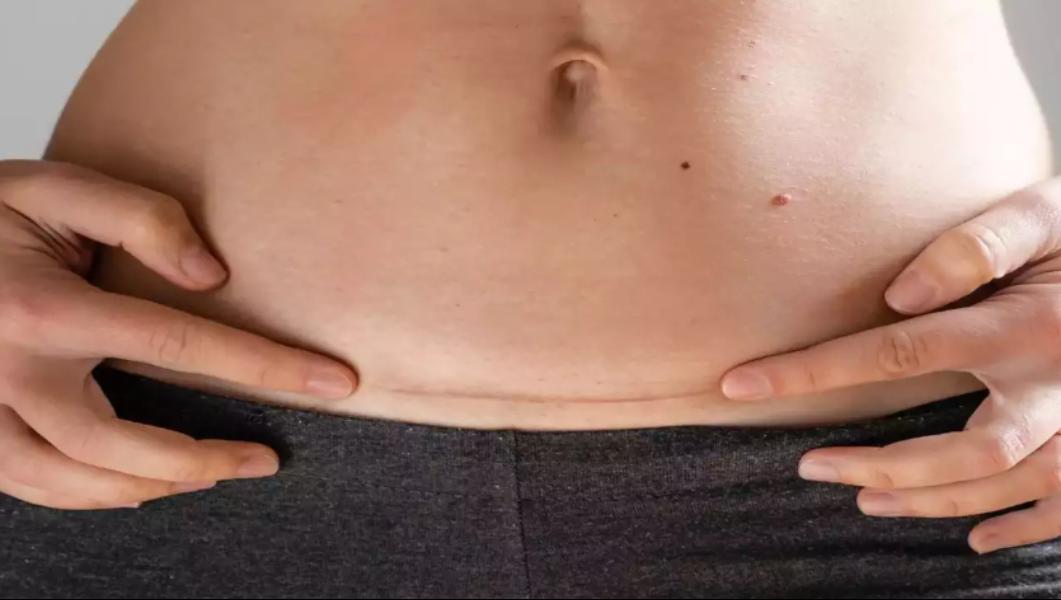 LSCS, or Lower Segment Caesare