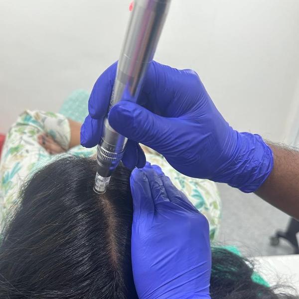 prp therapy for hair thinning