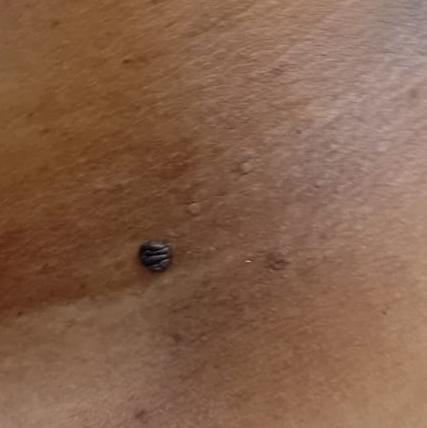 cyst removal in trichy