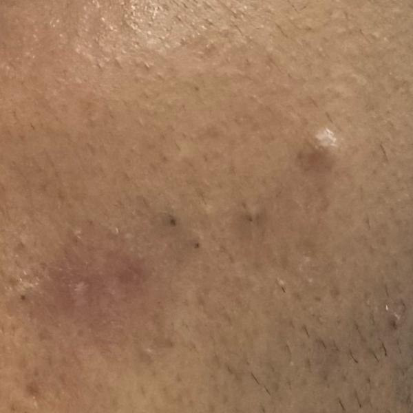earlobe repair expert in trich