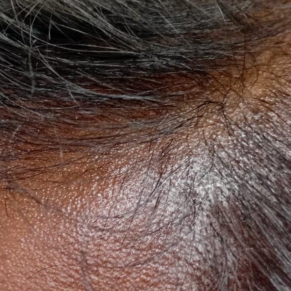best dermatologist for dandruf