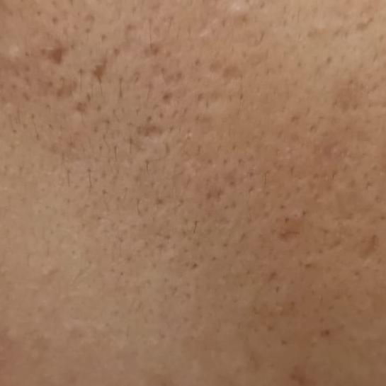 acne removal services trichy